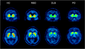 Detecting Parkinson's disease decades before symptoms appear