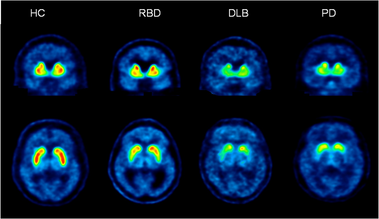 Detecting Parkinson's disease decades before symptoms appear