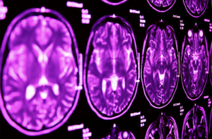 High blood pressure’s impact on white matter could be key to dementia prevention: Centre for Healthy Brain Ageing (CHeBA), UNSW Sydney